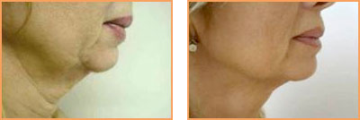 Cosmetic Injections: Fat Reduction and Face Lift