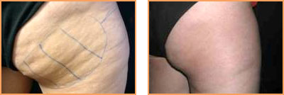 Cosmetic Injections: Fat Reduction and Face Lift