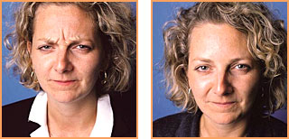Cosmetic Injections: Botox