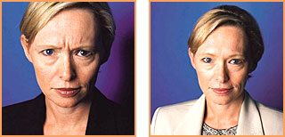 Cosmetic Injections: Botox