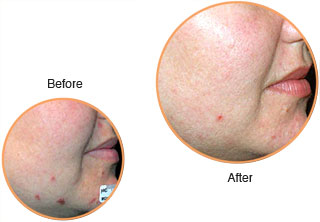 Cosmetic Injections: Laser Treatment: Treatment of Acne
