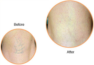 Cosmetic Injections: Laser Treatment: Leg Veins