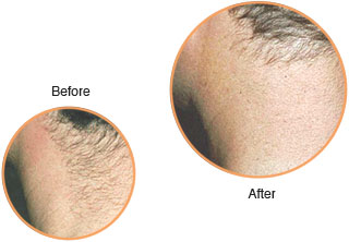 Cosmetic Injections: Laser Treatment: Unwanted Body Hair