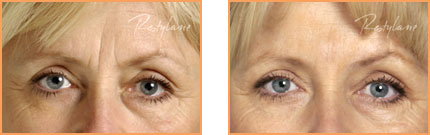 Cosmetic Injections: Restylane