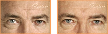Cosmetic Injections: Restylane