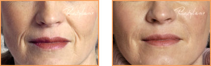 Cosmetic Injections: Restylane