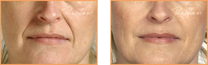 Cosmetic Injections: Restylane