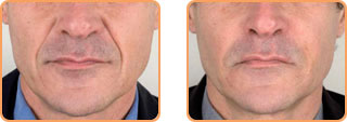 Cosmetic Injections: Teosyal