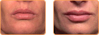 Cosmetic Injections: Teosyal