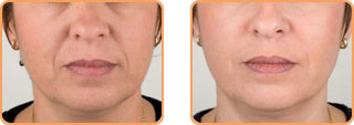 Cosmetic Injections: Teosyal